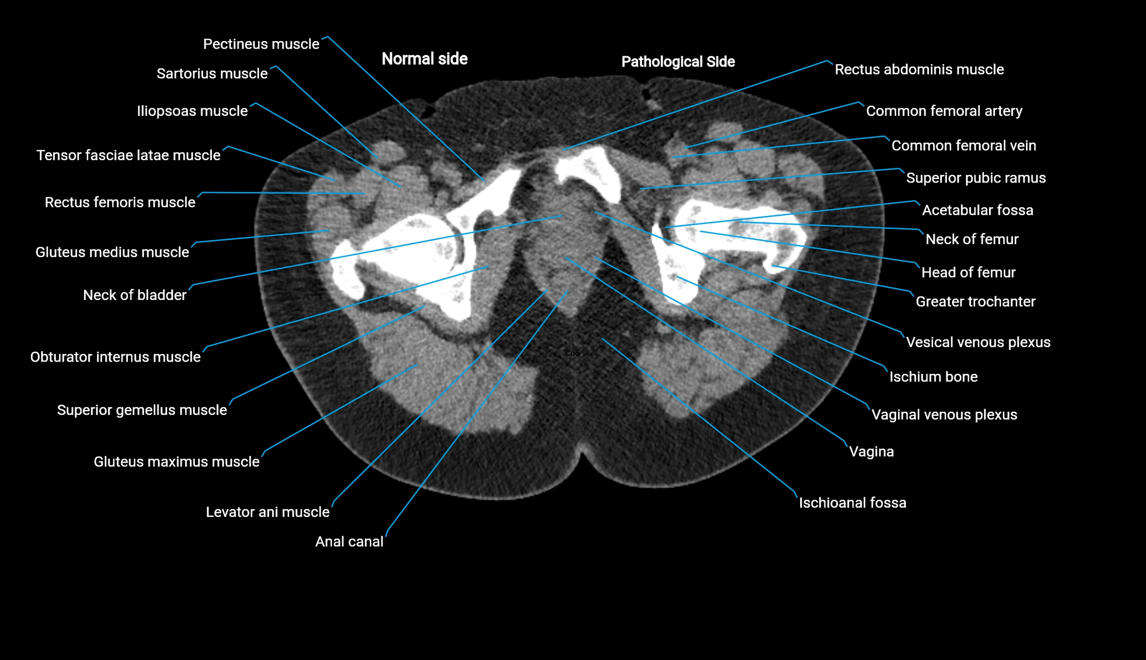 CT KUB axial cross sectional anatomy  radiology image -img-00201-00168.webp